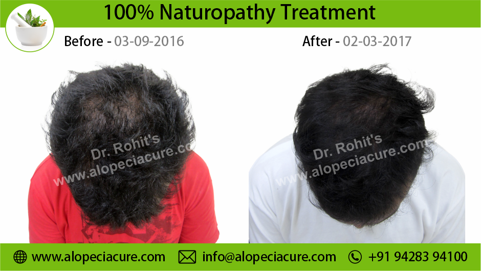 male hair loss treatment